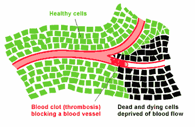 Blood clot