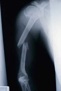 X ray of broken arm